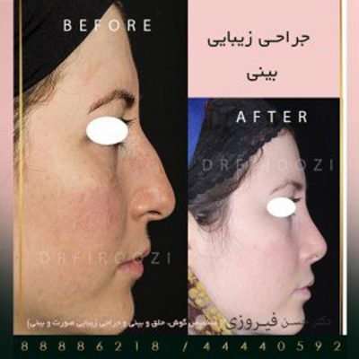 جراحی بینی استخوانی و هزینه